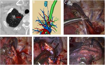Application of three-dimensional computed tomography bronchography and angiography in thoracoscopic anatomical segmentectomy of the right upper lobe: A cohort study